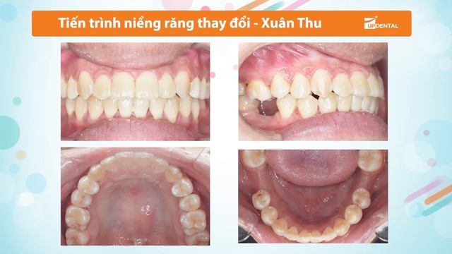 Khớp cắn không đều khắc phục hoàn toàn sau hơn 2 năm niềng răng смотреть онлайн