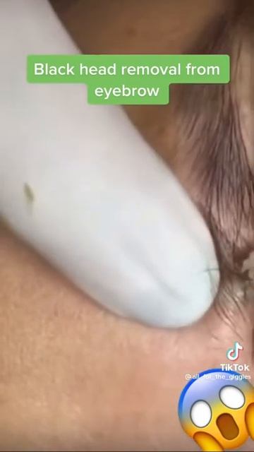Blackhead Removal from Eyebrow смотреть онлайн