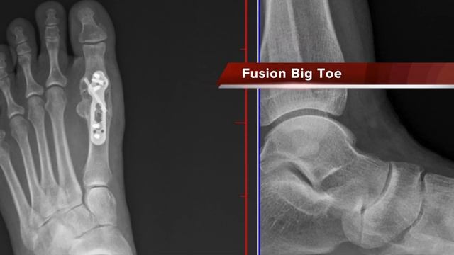 Hallux Rigidus - Big Toe Fusion смотреть онлайн