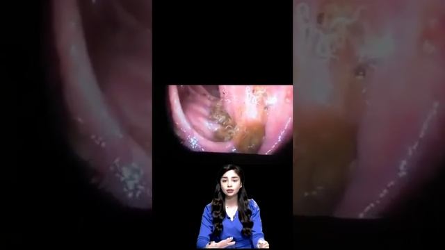 اخطر انواع الديدان المعوية التى تٌصيب الأطفال смотреть онлайн