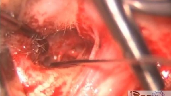 Операция на ухе: стапедопластика тефлоновым протезом.