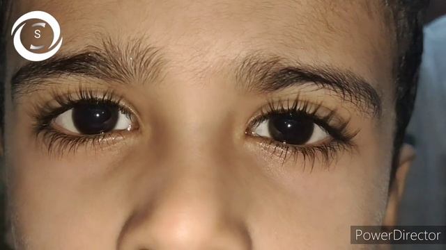 How to diagnose high myopia in children смотреть онлайн