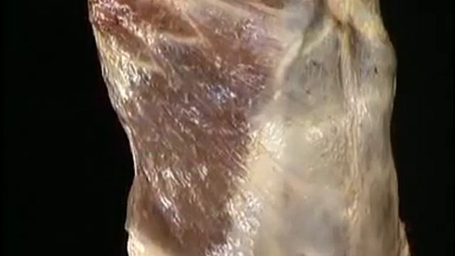 Abdominal wall pt 3 смотреть онлайн