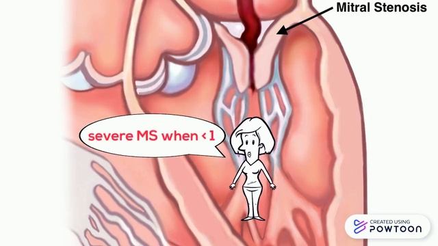 Mitral stenosis смотреть онлайн