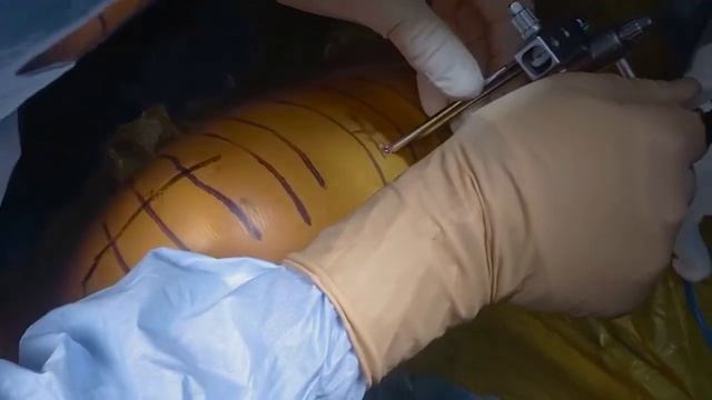 Robotic-Arm-Assisted Lateral Unicompartmental Knee Arthroplasty with a Fixed-Bearing Implant смотреть онлайн