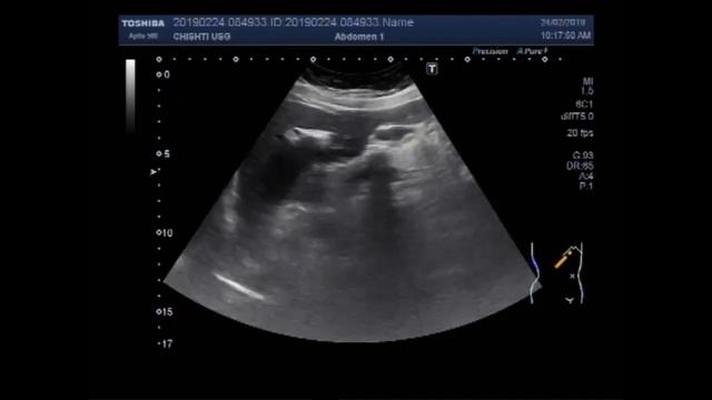Hepatic Hydatid Cyst. смотреть онлайн