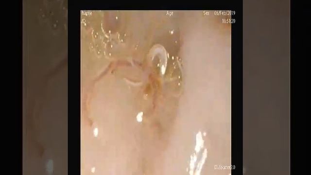 Ancylostoma duodenale in endoscopy смотреть онлайн