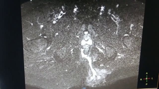 Preianal fistulogram MRI PELVIS / sktimepass смотреть онлайн