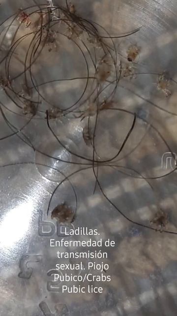 Ladillas (Crabs Pubic lice) Enfermedad de transmisión sexual. ETS/STDs. Piojo Pubico. смотреть онлайн