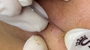 Blackhead On The Skin Of Young Girl | Làm Sạch Mụn Đầu Đen Trên Da Cô Gái Trẻ - SacDepSpa#250