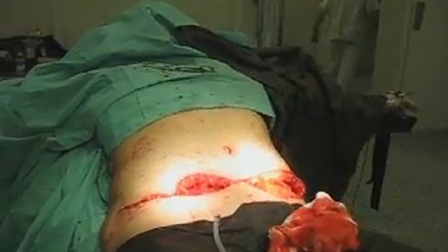 Абдоминопластика + липосакция 4-ая часть смотреть онлайн