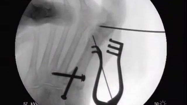 Hallux Varus Correction With MiniTightRope смотреть онлайн