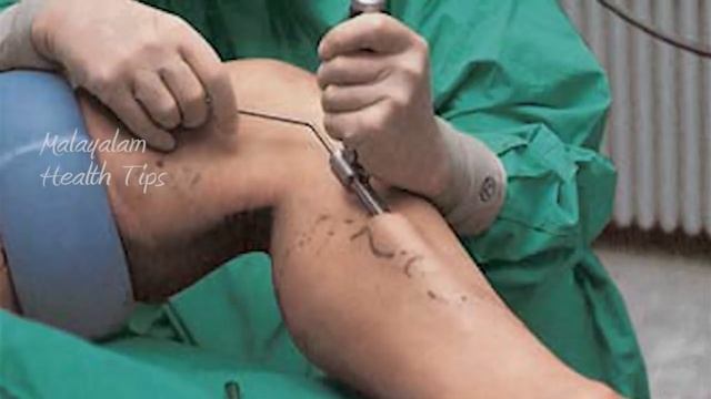 വെരികോസ് വൈൻ എങ്ങനെ തിരിച്ചറിയാം # Varicose Veins Malayalam Health Tips # Malayalam Health Tips 201 смотреть онлайн