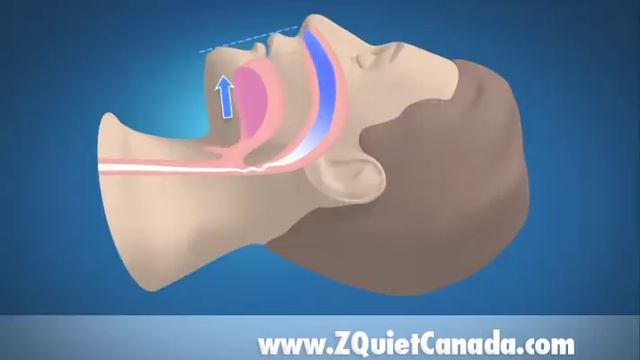 ZQuiet Canada - Breakthrough Anti-Snoring Device смотреть онлайн