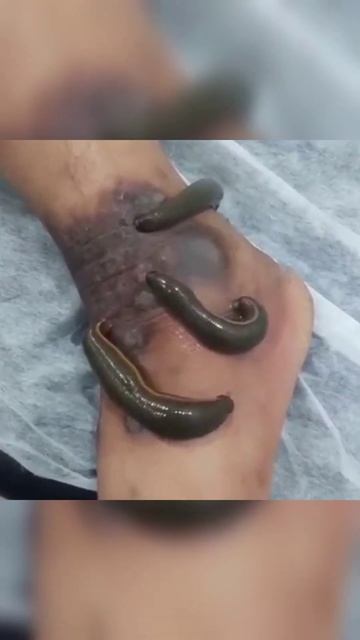 jonk sy hony wala heran kun ilaj # hijama ka pahla treeka e ilaj # short video viral смотреть онлайн