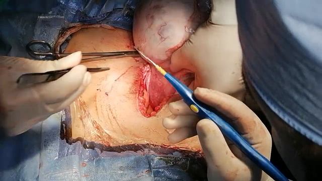 Myomectomy Dr Ahmed Abdelkader - Part 1 смотреть онлайн