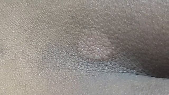 Tinea Corporis смотреть онлайн