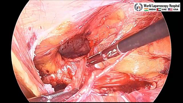 Bilateral Inguinal Hernia Surgery Trans Abdominal Preperitoneal Repair смотреть онлайн
