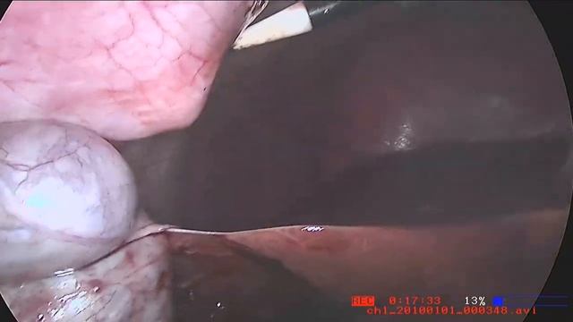 Lapchole done by Dr. Navneet, UNA with Full HD Camera MODEL FHD111DX, MAKE: M/s proMIS Germany смотреть онлайн