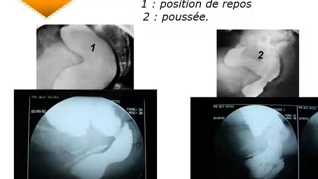 GASTRO-ENTEROLOGIE explorations ano-rectales смотреть онлайн