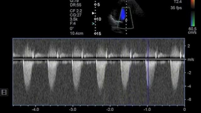 congenital aortic severe stenosis in bicuspid valve смотреть онлайн