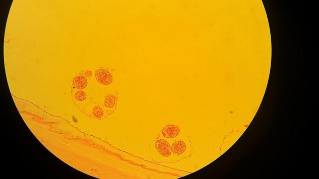 Echinococcus granulsus hydatid cyst wall смотреть онлайн