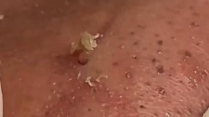 Выдавливание черных точек и прыщей