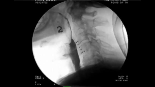 Modified Barium Swallow Case Study - Michael Groher | MedBridge смотреть онлайн