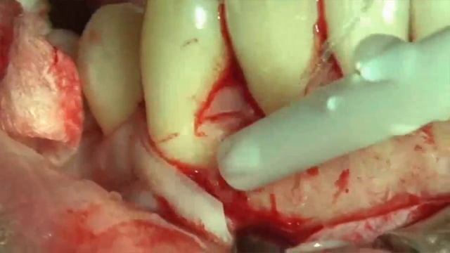 849 Live Surgery by Straumann® смотреть онлайн