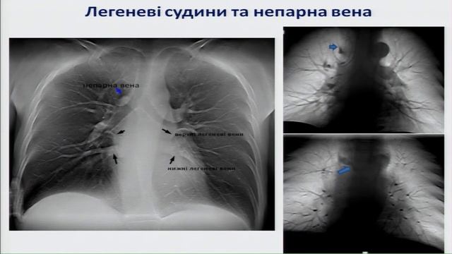 07 Цифровий томосинтез грудної клітки свіжий погляд на анатомію легень і клінічне застосування смотреть онлайн