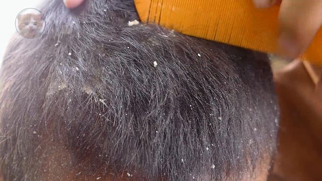 DRY SCALP !! Big Flakes Dandruff Scratching Satisfying Video #990