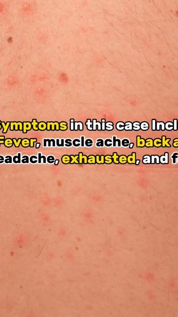 Difference between Corona and Monkeypox virus || Shorts || Microbiology смотреть онлайн