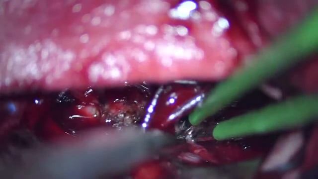 MIddle fossa transventricular and subtemporal approach for meningioma resection смотреть онлайн