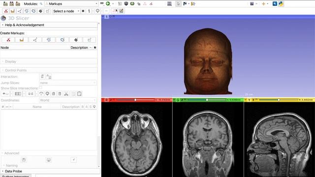 Landmark Templates in 3D Slicer смотреть онлайн