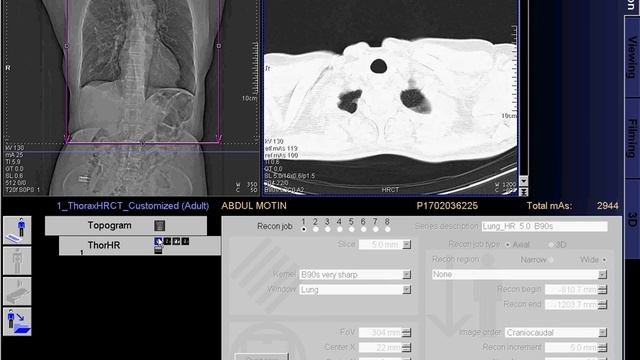 HRCT Scan of Chest full work " SIEMENS" смотреть онлайн