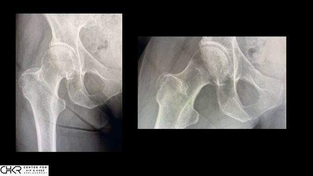 X-Ray vs MRI in the Diagnosis of Hip Arthritis смотреть онлайн