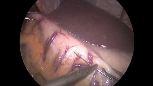 Laparoscopic Placement of Gastric Electrical Stimulator for Gastroparesis смотреть онлайн