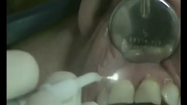 Пародонтология диодный лазер смотреть онлайн