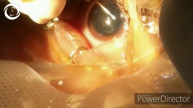 Clear lens extraction CLE in high myopia смотреть онлайн
