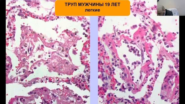 Лекция: патологическая анатомия заболеваний легких. 18.03. 8.30 смотреть онлайн