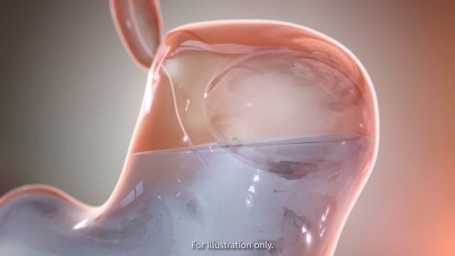 About the Obalon Balloon System for Weight Loss смотреть онлайн