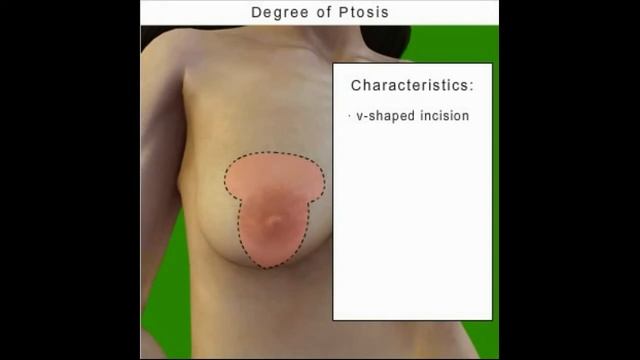 Nâng Ngực Xệ, Thu nhỏ ngực xệ, Bác sĩ Thái, Bệnh viện thẩm mỹ Việt Mỹ смотреть онлайн