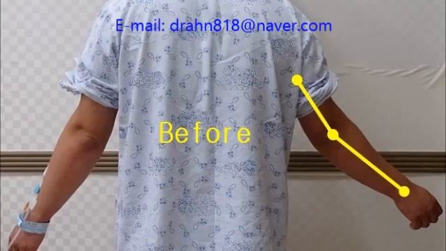 Elbow valgus deformity(cubitus valgus surgery) by Dr. Ahn смотреть онлайн