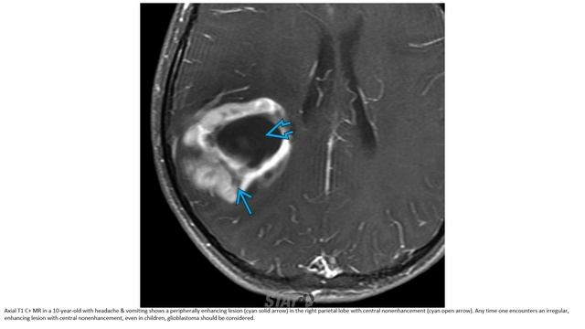 Glioblastoma Imaging смотреть онлайн