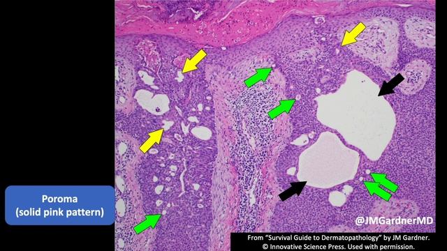 Skin Adnexal Tumors 101: A Basic Approach for General Pathologists смотреть онлайн