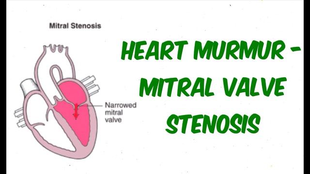 Mitral Stenosis - Auscultation Sound смотреть онлайн