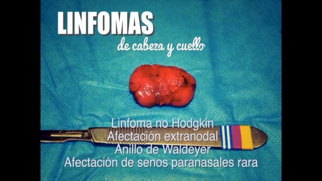 Caso clínico: linfoma de senos paranasales смотреть онлайн