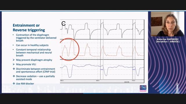 Patient ventilation asynchronies a practical approach Katerina Vaporidi 2022
