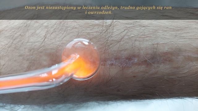 Ozonoterapia Ozone DTA leczenie ozonem смотреть онлайн