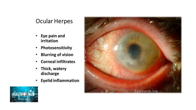 Common Eye Problems Health Talk смотреть онлайн